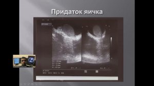 Ультразвуковая анатомия органов мошонки