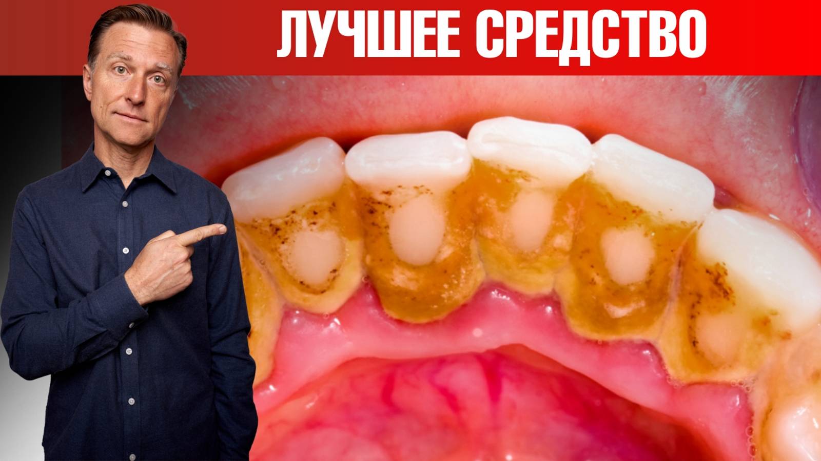 Зубной налет и зубной камень? Лучшее средство! Сделайте сами🙌 смотреть онлайн