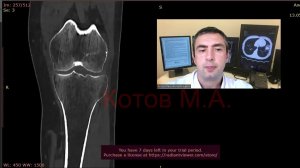 Перелом мыщелка большеберцовой кости. Ролик №60