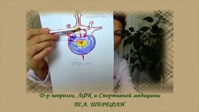 "Рассасывается ли " грыжа позвоночника?" смотреть онлайн