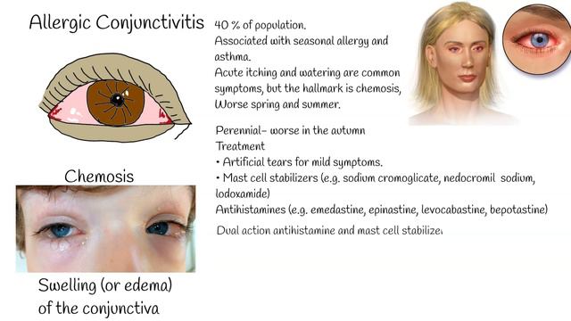 Pink Eye (Conjunctivitis) - Viral, Bacterial and allergic conjunctivitis. Symptoms and treatment смотреть онлайн