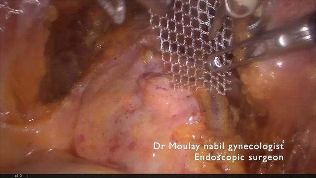 Steps for a safe quick and bloodless sacrocolpopexy смотреть онлайн