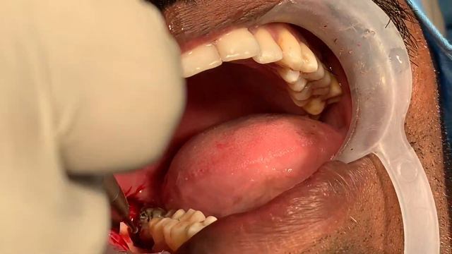Mesioangular impacted wisdom tooth removal - Third molar extraction under local anesthesia video смотреть онлайн