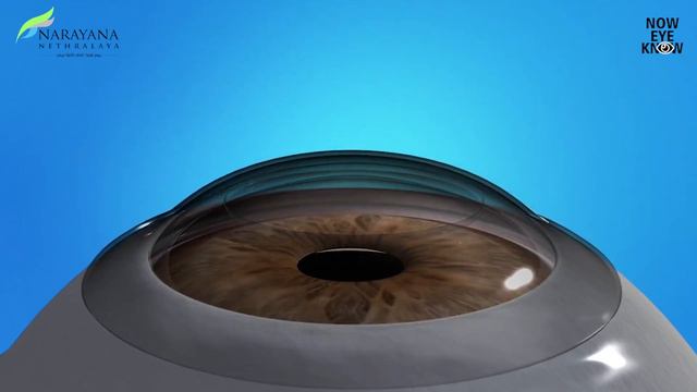 PRK (Photorefractive Keratectomy) Laser Eye Surgery Explained | Dr. Pooja Khamar | Hindi смотреть онлайн