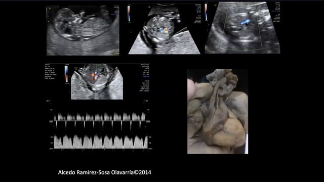 Medicina Fetal Clase 5 Screening de cardiopatias Congenitas 24 9 смотреть онлайн