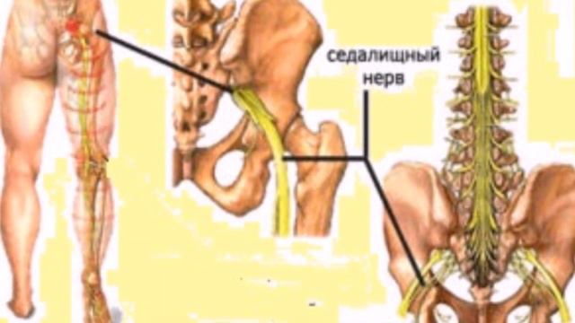ИШИАС - НЕВРАЛГИЯ СЕДАЛИЩНОГО НЕРВА. Эффективное лечение. Метод гирудотерапии - лечение медицинскими смотреть онлайн