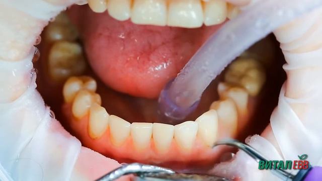 Профессиональная гигиена полости рта смотреть онлайн