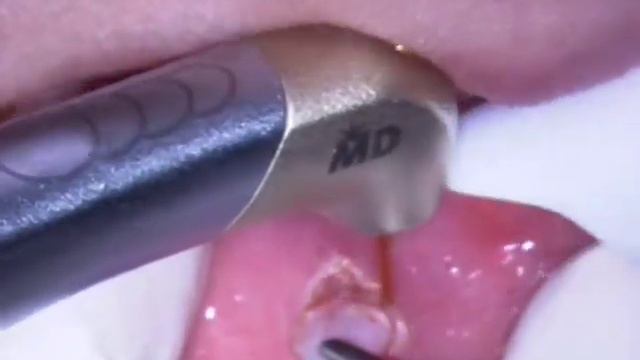 Eliminacion de Fibroma смотреть онлайн