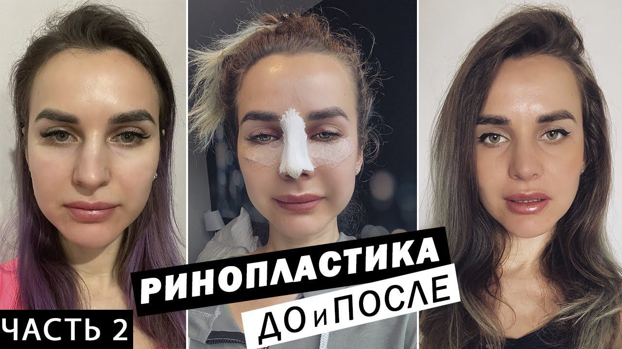 РИНОПЛАСТИКА в Санкт-Петербурге | До и ПОСЛЕ | Реабилитации после ринопластики. Часть 2 смотреть онлайн