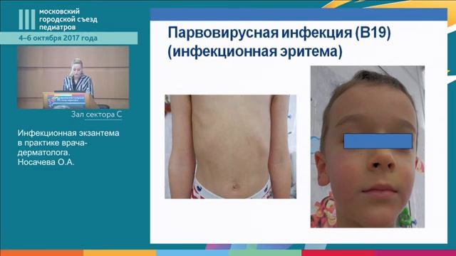 Симпозиум "Инфекционная экзантема в практике врача-педиатра" смотреть онлайн