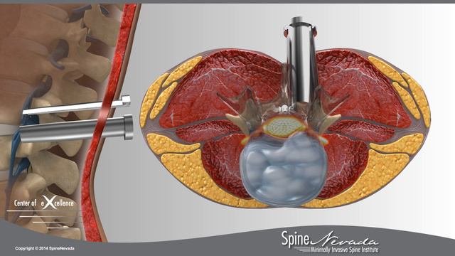 Lumbar Microdiscectomy - Spine Center Northern Nevada, Northern California - Spine Surgery смотреть онлайн