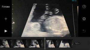 Мальчик на УЗИ 20 недель