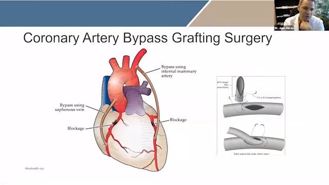 Coronary Artery Bypass Surgery Explained By Dr. Juan Abreu