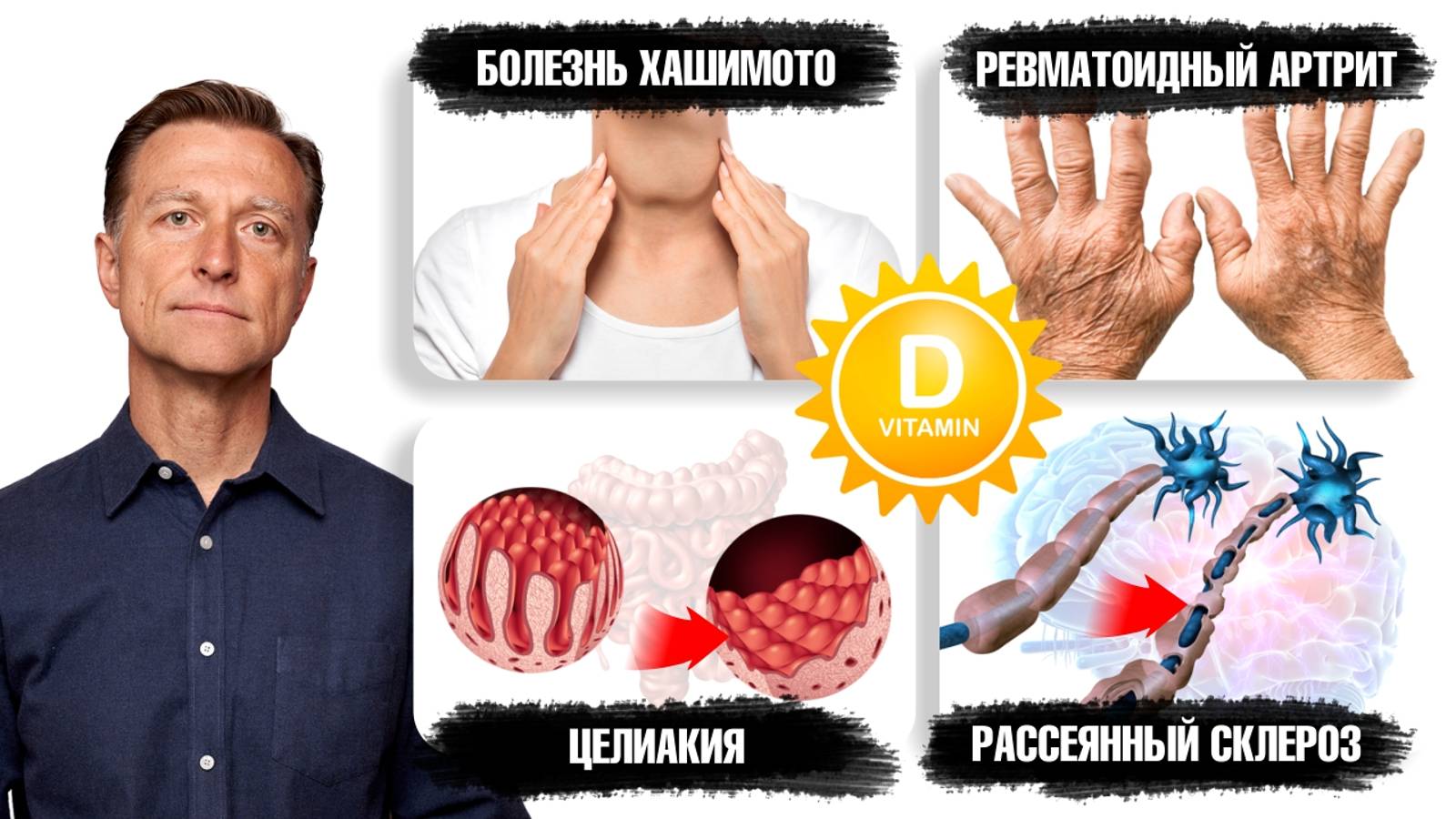 Витамин D – главный витамин при аутоиммунных заболеваниях🔥 смотреть онлайн