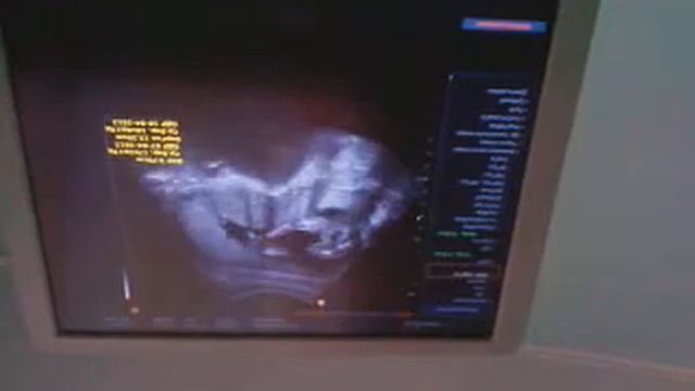 УЗИ-22 НЕДЕЛИ,ДЕВОЧКА!! смотреть онлайн