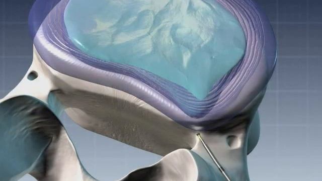 nucleoplasty- cat .wmv смотреть онлайн