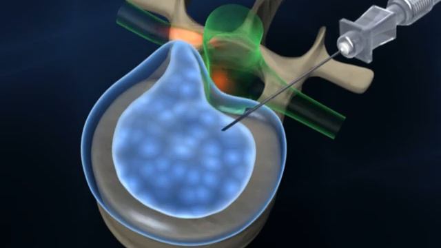 Percutaneous Laser Discectomy Or PLDD