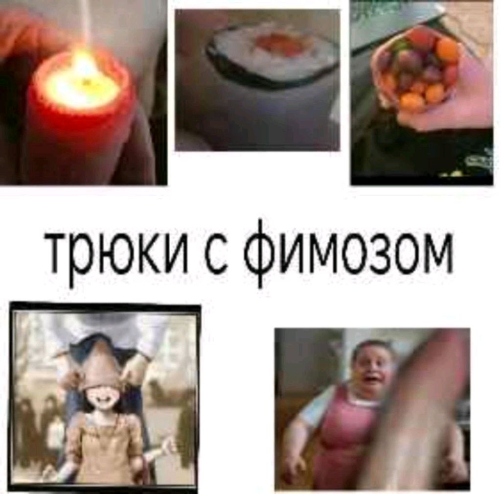 фимоз 4 степени