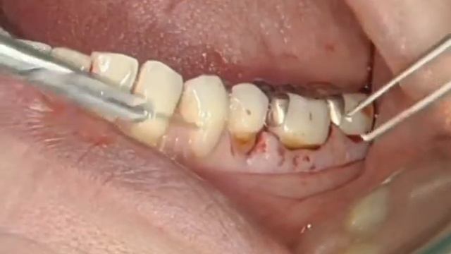 endogain defeito de furca-Straumann-drbrunorodrigues-goiânia смотреть онлайн