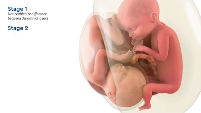 Twin-to-Twin Transfusion Syndrome And Fetoscopic Laser Surgery