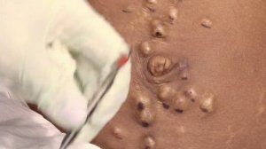 Dr. Sandra Lee Helps Woman Get Her Flat Tummy Back | Dr. Pimple Popper