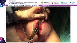 Показательная операция Мельникова Дмитрия Владимировича. LIVE SURGERY
