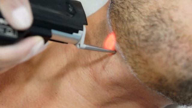 Процесс лазерной эпиляции бороды! смотреть онлайн