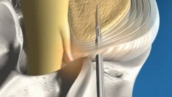 Hydrocision SpineJetXL