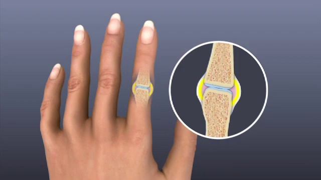 Rheumatoid Arthritis - Mayo Clinic смотреть онлайн
