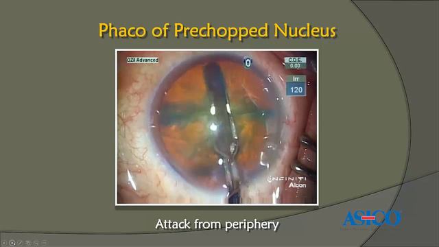 10,000 Cataract Surgery a Year: How to Attain Premium Surgical Outcomes смотреть онлайн