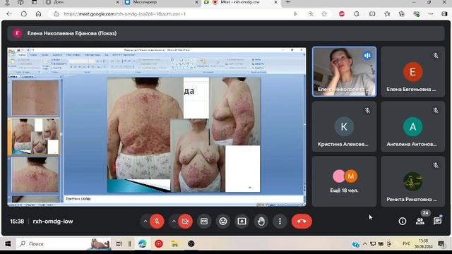 лекция дерматовенерология|Псориаз