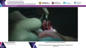 Первичная сохраняющая риносептопластика из открытого доступа с использованием УЗ- аппарата Piezo