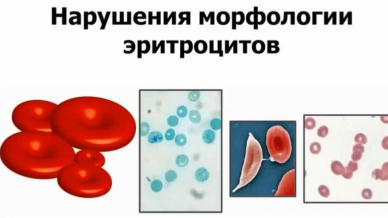 Нарушения морфологии эритроцитов смотреть онлайн