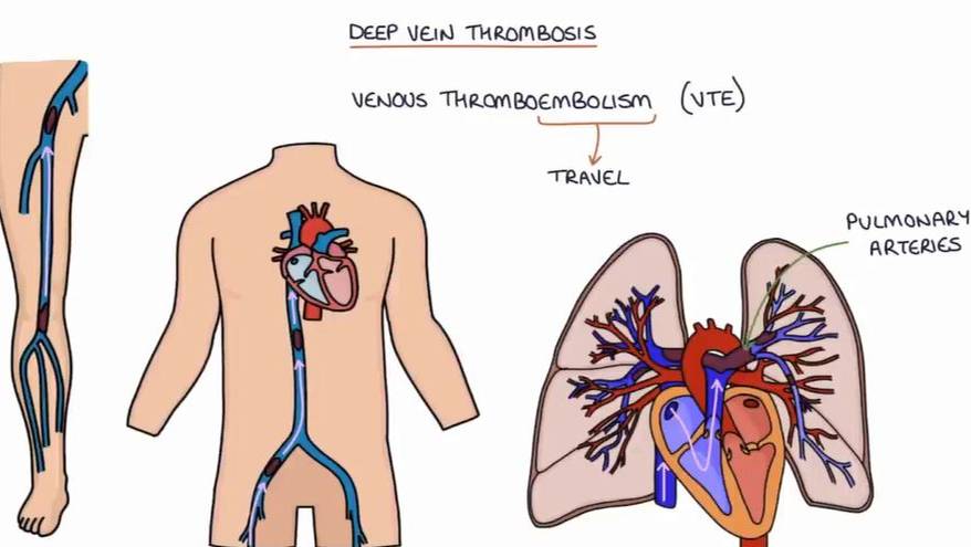 Тромбоз глубоких вен (ТГВ) смотреть онлайн