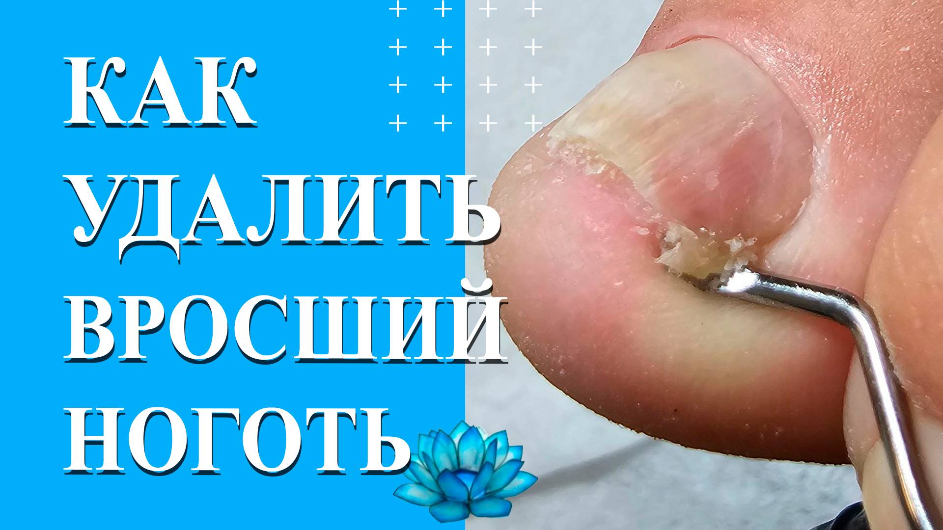 Вросший ноготь на ноге. Удаление вросшего ногтя. смотреть онлайн