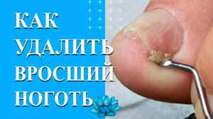 Вросший ноготь на ноге. Удаление вросшего ногтя.