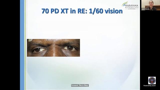 Lecture#247, Strabismus#34, Dr Jyoti Matalia, Step-by-step Strabismus surgery, Oct 19, 2022, 8:00 P смотреть онлайн