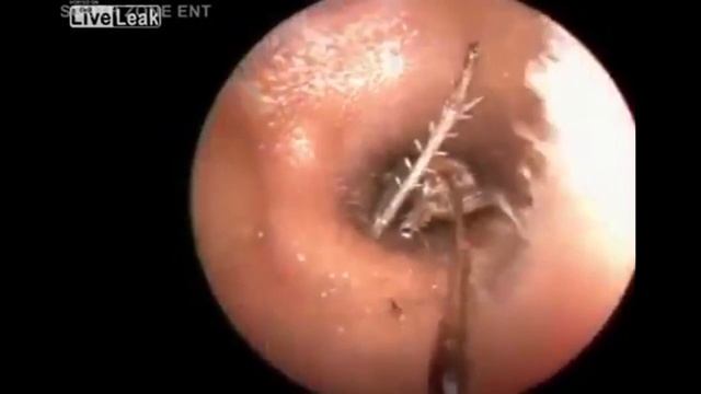 Мужчина жаловался на щекотание в ухе. Обнаружив причину, врач чуть не поседел