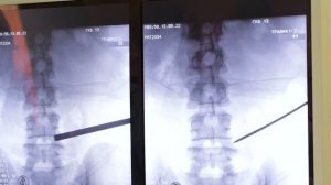 Виды операций при грыже и стенозе позвоночника: TLIF и Эндоскопия