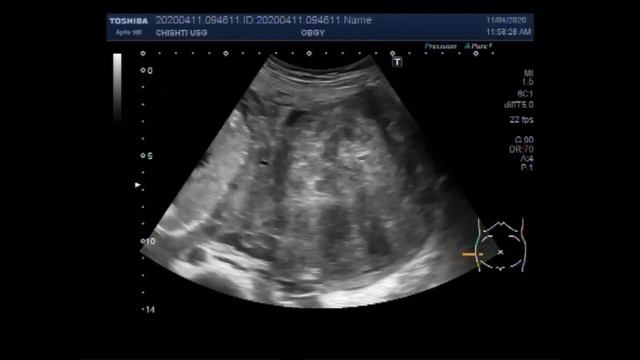 Ultrasound Video showing Pregnancy with a uterine mass. смотреть онлайн
