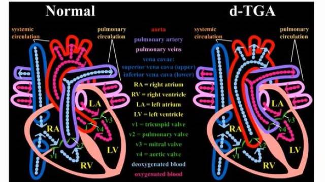 Цианотические врожденные пороки сердца смотреть онлайн
