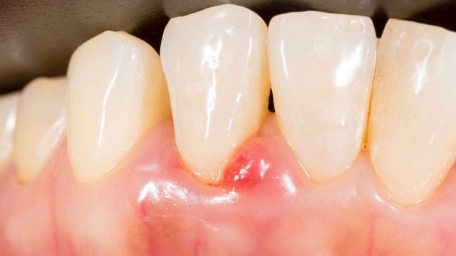 Diş Eti Hastalığı Çeşitleri Nelerdir? | Gingivitis ve Periodontitis | Diş Eti Hastalıkları-02 смотреть онлайн