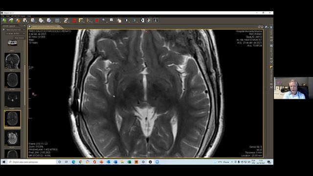 IESS/ESTM webinar series: Global Epilepsy Surgery Technique Rounds смотреть онлайн