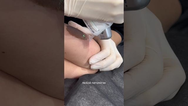 Lutronic Clarity II | Beauty Clinic Лилии Дышлевой смотреть онлайн