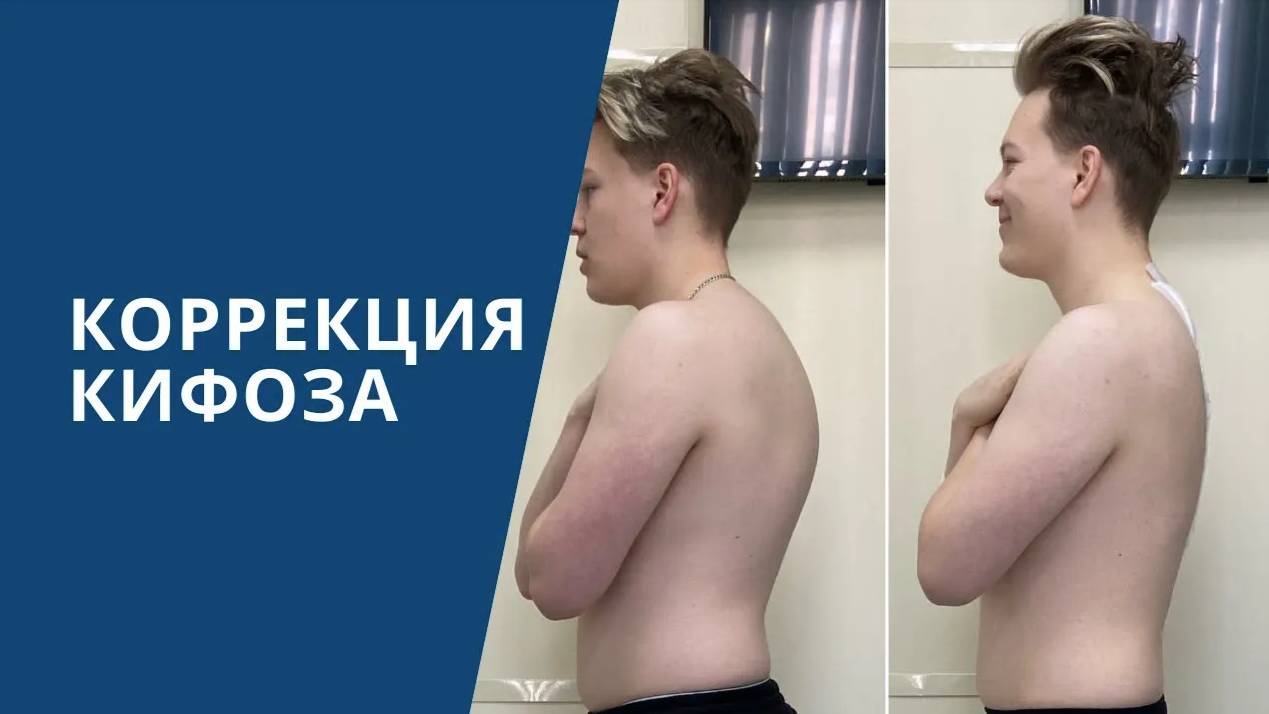 Лечение кифоза позвоночника смотреть онлайн