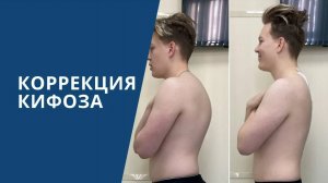 Лечение кифоза позвоночника