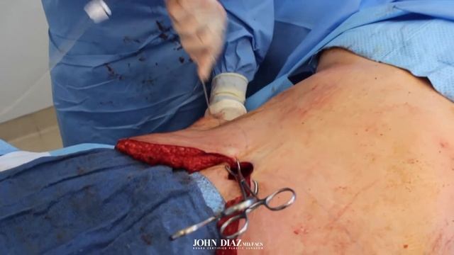 Tummy Tuck Video: A Step by Step Procedure смотреть онлайн