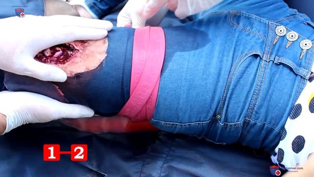 Первая помощь при открытом переломе смотреть онлайн