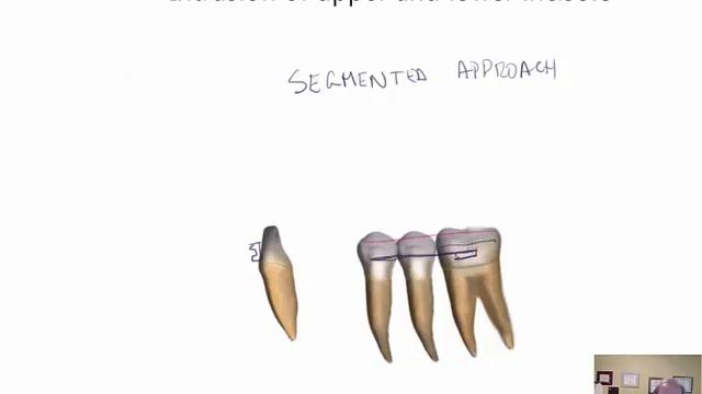 Pure intrusion of lower incisors смотреть онлайн