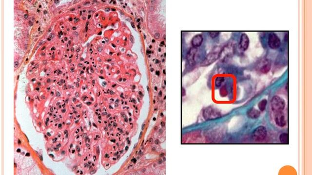 Syndrome Néphritique Aiguë meilleure explication par Pr MISSOUM смотреть онлайн